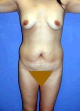Breast Augmentation, Tummy Tuck (Abdominoplasty) before 394930