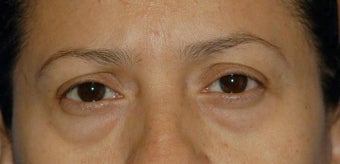 Upper and lower lid blepharoplasty and Fat Transfer to lower lids and midface before 307125