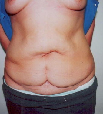 Breast Augmentation with an Abdominoplasty (Tummy Tuck) before 236090