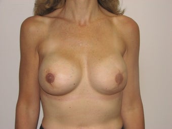 Breast reconstruction after mastectomy (after photos only) after 162800