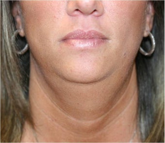 SmartLipo of Neck - Anterior View before 109276