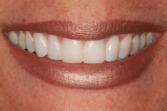 Minimal Prep Veneers/ Gum LIft after 194542