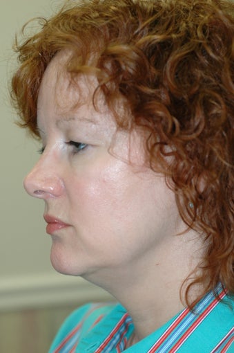 Neck lift, eyelid surgery before 437149