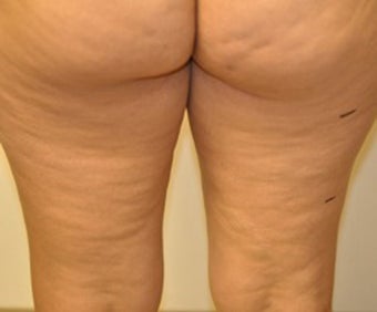 VASER Shape to Legs before 433059