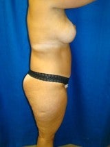 Breast Lift with Implants, Extended Tummy Tuck, 399479
