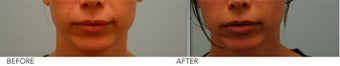 Upper Lip Reduction before 339201