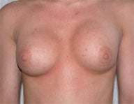 Bilateral Breast Augmentation before 112070