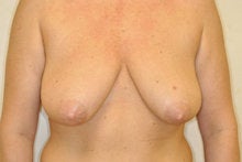 Breast Lift without Implants before 341012