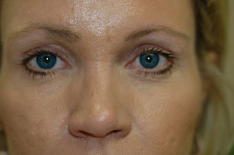Forehead Lift after 434857