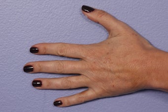 Radiesse to Hands after 308304