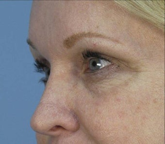 Restylane under Eyes before 135868