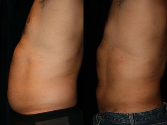 Liposuction after 420935