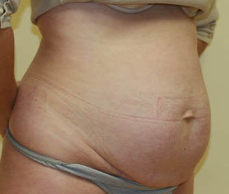 Abdominoplasty (Tummy Tuck) before 216685