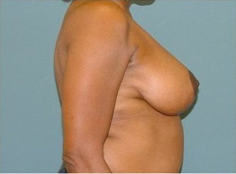 Breast Reduction 97010