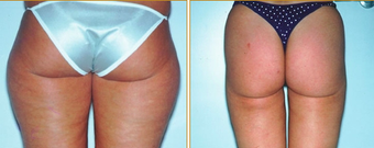 Liposuction before 271073