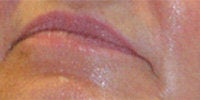 Restylane before 272044