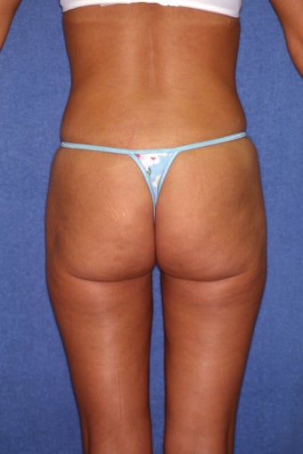 Tummy Tuck with Liposuction 410981