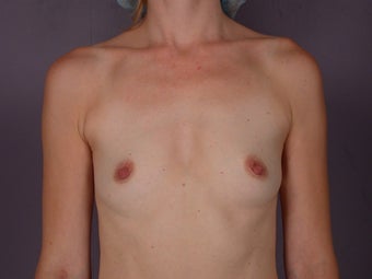 Breast Implants before 342221