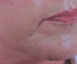 Chin rejuvenation before 91308