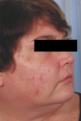 Laser Acne Treatment before 82969