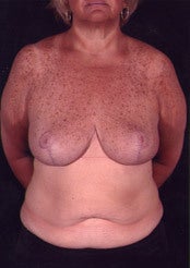 Minimal Scar Breast Reduction after 85815