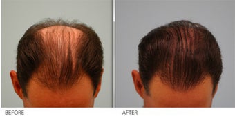 Hair Restoration before 396053