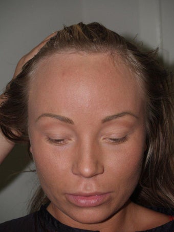 Surgical Hairline Advancement Procedure before 535779