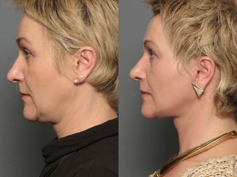 Facelift 338469
