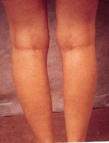 Women's Calf Augmentation before 519045
