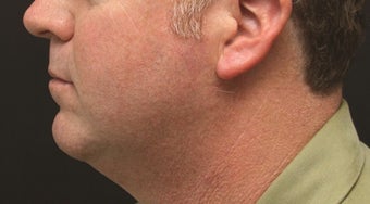 Chin Implant and Laser-Assisted Lipocontouring of Neck before 406765