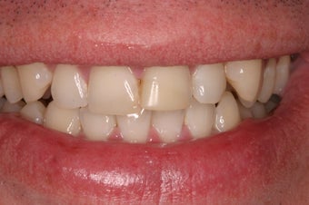 porcelain crowns 330389