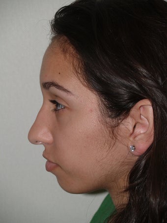 Rhinoplasty- external approach before 174850