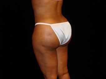 Buttocks Augmentation 517504