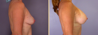 Breast Implants before 271067