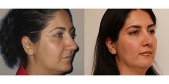 Facial Rejuvenation, non-surgical 450125