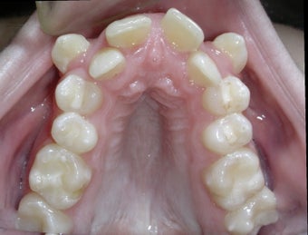 Damon Braces 378589