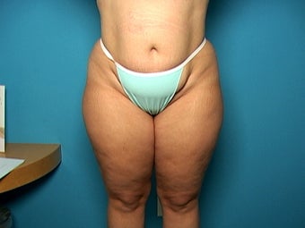 Liposuction and Abdominoplasty before 134587