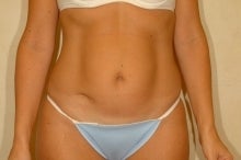 Liposuction and Abdominoplasty before 74760