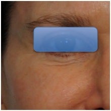 TCA Peel - Lower Lids before 70908