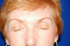 Facelift, Intense Pulsed Light 132103