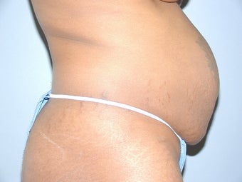 Abdominoplasty with power-assisted liposuction before 512244