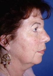 Facelift and Eyelid Surgery 316338