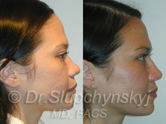Asian Rhinoplasty before 624582