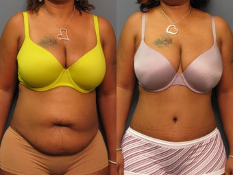 Tummy tuck before 264466