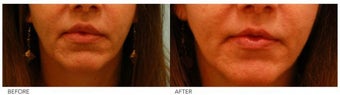 Lip Reduction/Lip Correction before 136725