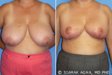 Breast Reduction before 217807