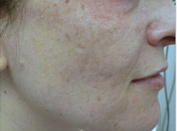 Fractional laser used to treat acne scars after 460041