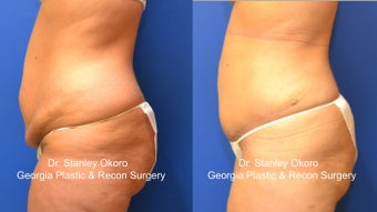 Mini Tummy Tuck 568404