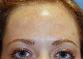Chemical Peel ~ Vitalize before 166178