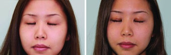 Double eyelid surgery suture after 548949